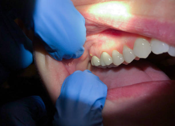 Best Emergency Dental Care for Broken or Chipped Teeth in Starkville, MS
