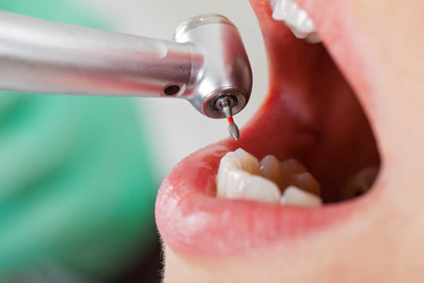 Best Emergency Root Canal Treatment in Starkville, MS